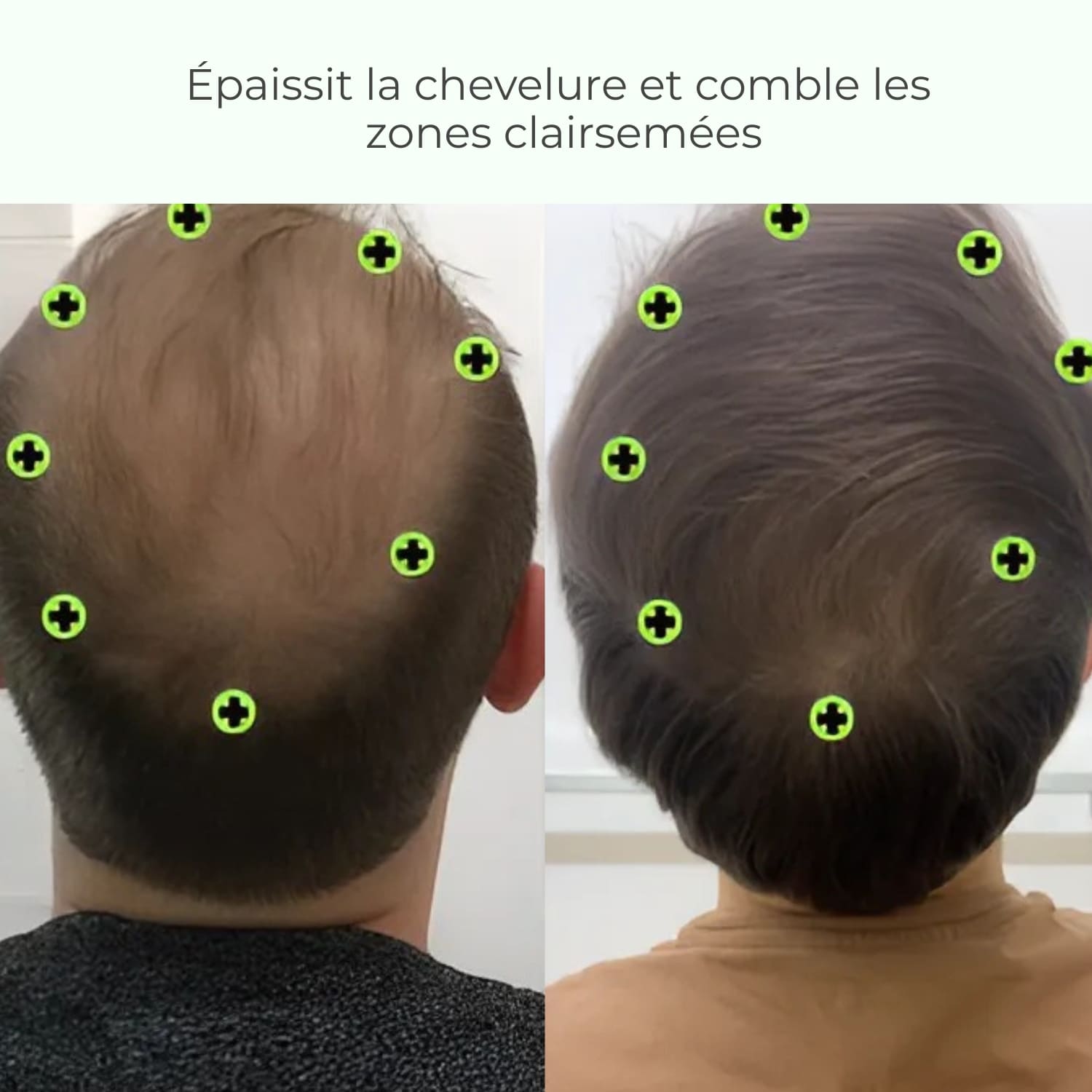 Capilys - Solution de Repousse Capillaire par Micro-Infusion