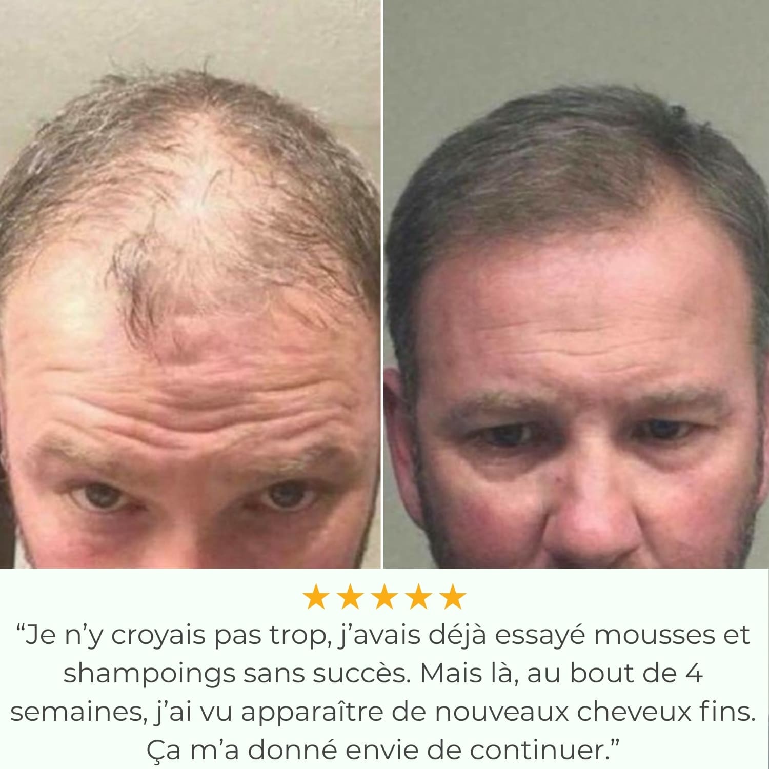 Capilys - Solution de Repousse Capillaire par Micro-Infusion