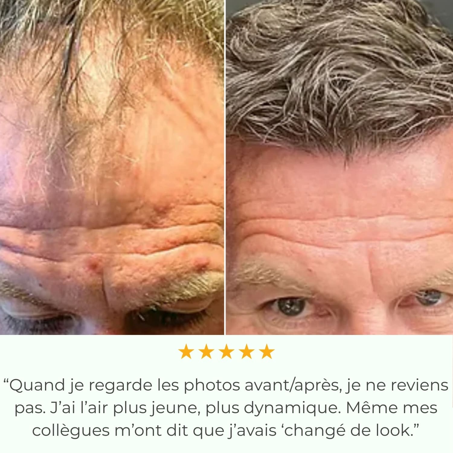 Capilys - Solution de Repousse Capillaire par Micro-Infusion