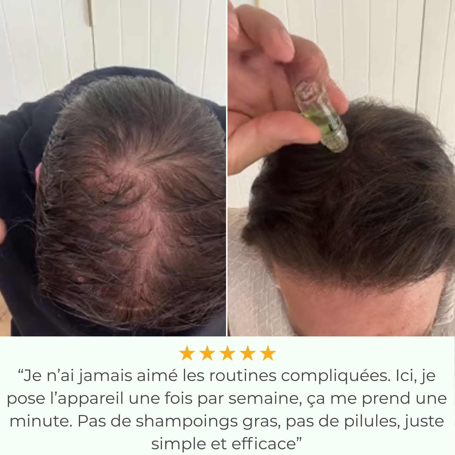 Capilys - Solution de Repousse Capillaire par Micro-Infusion